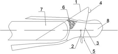 New technique for the treatment of fresh bony mallet finger: A <mark class="highlighted">retrospective case series</mark> study